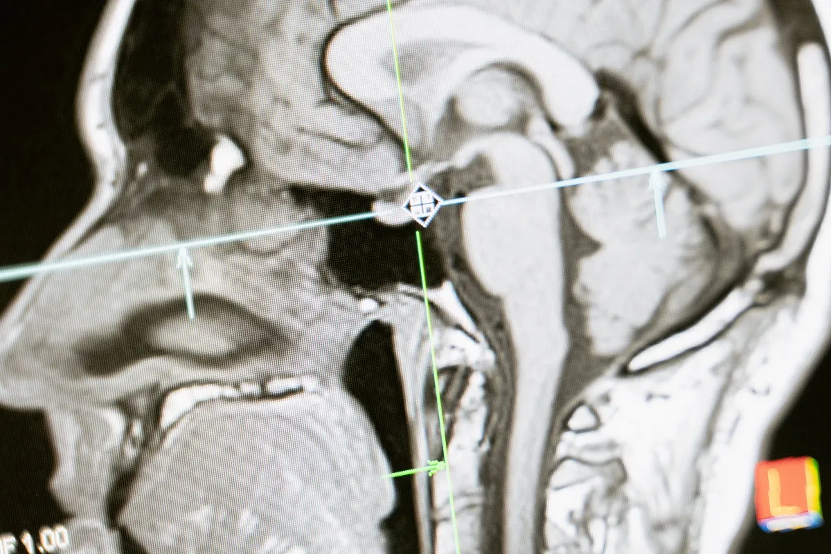 Afectaciones cerebrales por COVID - 19
